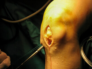 knee surgery cruciate ligament operation
