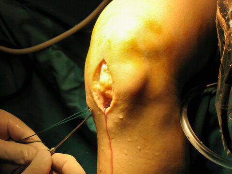 knee surgery cruciate ligament operation