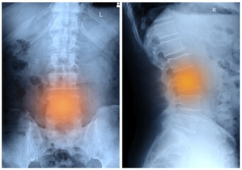x-ray images lumbar spine