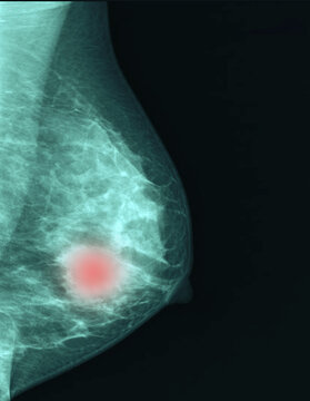 breast cancer images