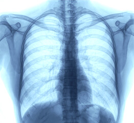 Lung Chest x-ray images