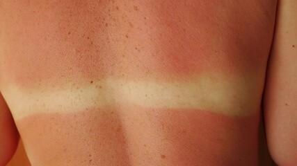 A woman's back is charred in the sun. Strong tan. Red skin from solar ultraviolet radiation. Dangerous sun exposure in the summer.
