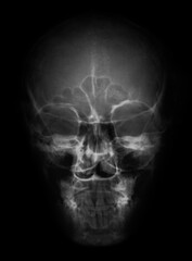 skull x ray