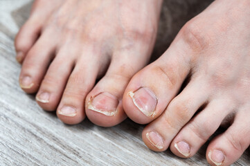 broken and ingrown ugly toenails of a sloppy girl