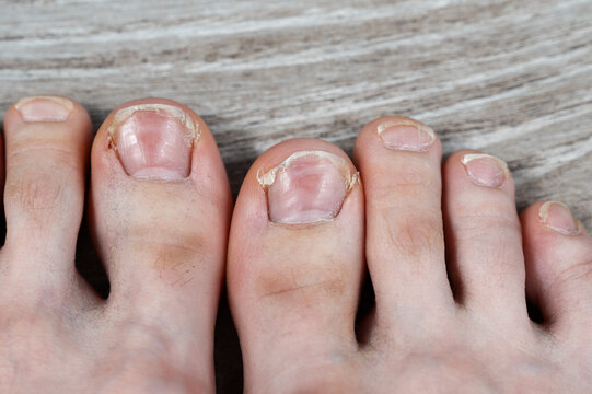 dirty toes with hair and ingrown cracked nails
