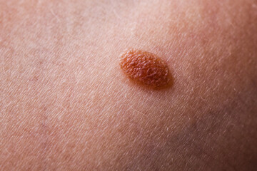 Closeup brown mole on caucasian woman skin.