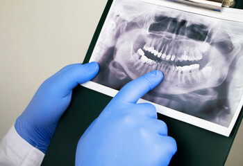 A dentist doctor examines a radiography of the teeth of a patient who has problems and teeth are inserted. The concept of research and diagnosis