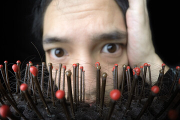 Close up hairloss on comb. Asian man with worry expression in the background