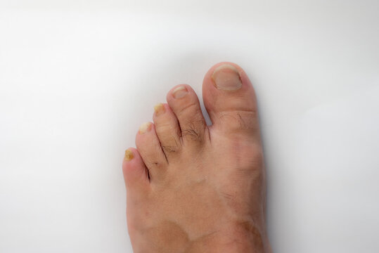 feet showing nail with 
Onychogryphosis