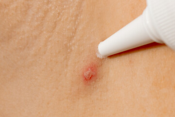 Woman applying cream on skin body ill with chickenpox