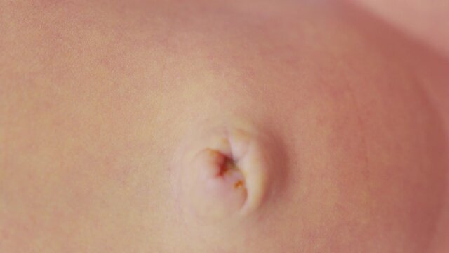 Newborn baby umbilical cord, first week of life.