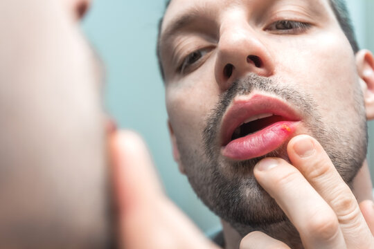 Unshaven man looks in mirror at sore lip with cold sore or herpe