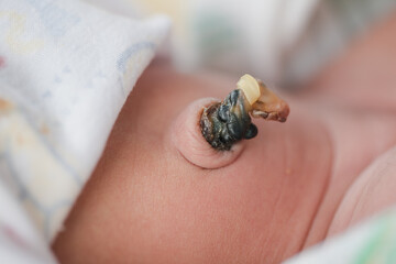 Asian newborn baby navel