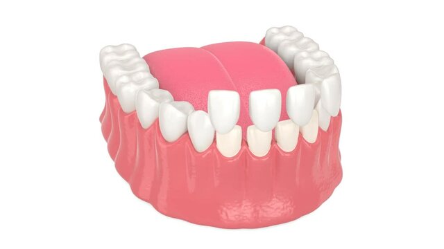 Lower jaw with installing dental veneers over white background
