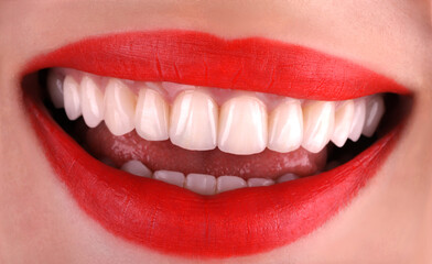 Perfect healthy teeth beautiful wide smile bleaching procedure whitening of young smiling attractive sexy red lips woman. Dental restoration treatment Close Up oral care, stomatology Dentistry