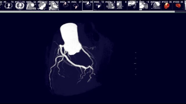 CTA Coronary artery 3D rendering image or coronary tree mip mip technique turn around on the screen for diagnosis of vessel coronary artery stenosis .