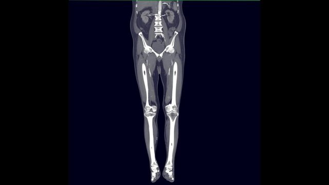 CTA femoral artery run off Coronal mip view.