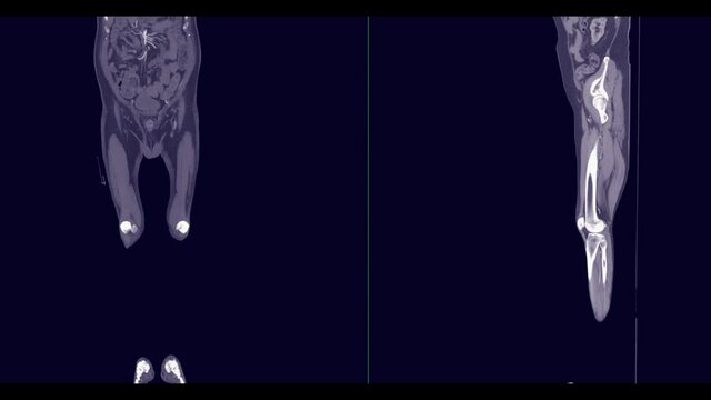 CTA femoral artery run off Coronal mip and sagittal mip view.