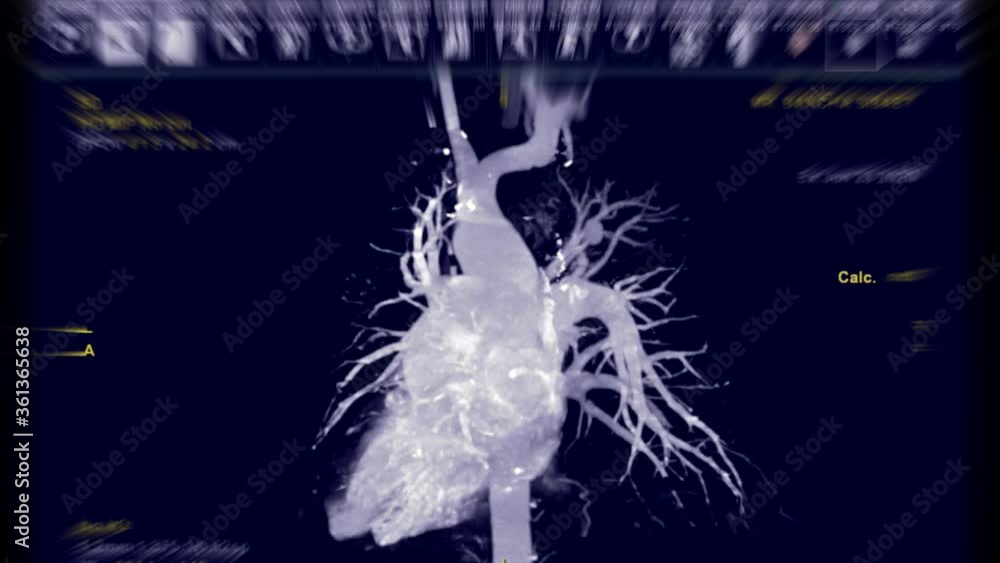 Aufkleber cta thoracic aorta 3d rendering with pulmonary artery mip technique turn around on the screen.