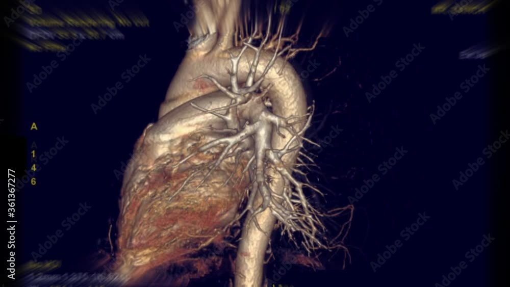Poster cta thoracic aorta 3d rendering with pulmonary artery turn around on the screen.