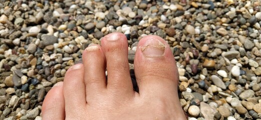 Toes with fungus - the concept of skin diseases in the summer on the beach