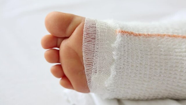 Children's leg in cast on a white bed in the orthopedic department after first aid. Swelling of external pain in perimaleolar soft tissues