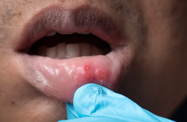 Close up mouth of asian man with aphthous stomatitis