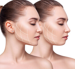 Young beautiful woman with lifting lines before and after chin correction. Over white background.