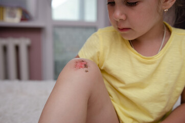 A little sad girl examines and processes her Scraped broken knees. Childhood injuries