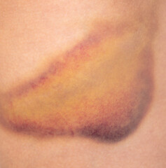 Closeup bruise on human skin as a background.
