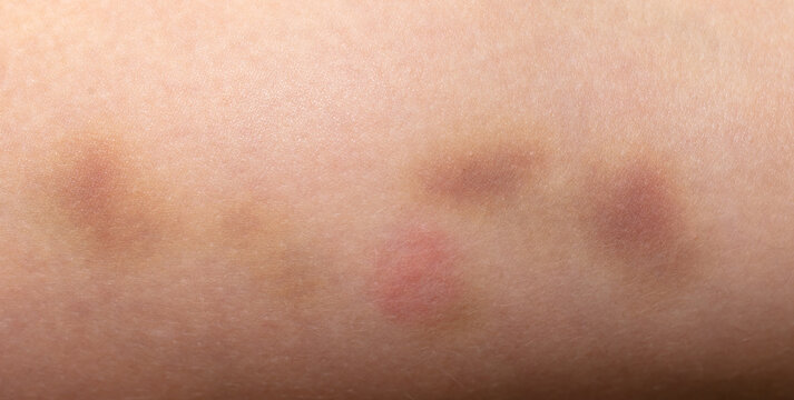Closeup bruise on human skin as a background.
