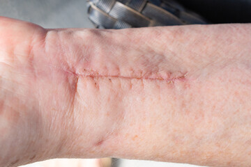 Scar on a woman's wrist