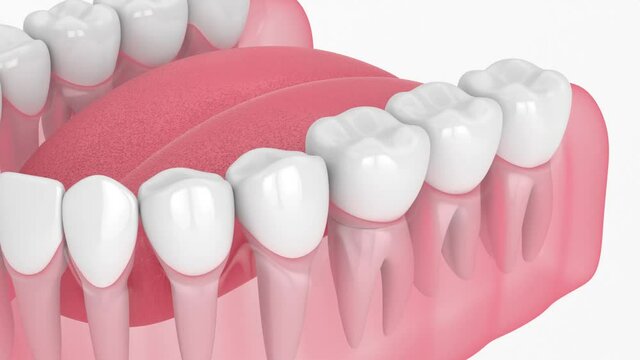 Jaw with dental crown embed on reshaped tooth over white background