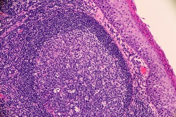 Chronic Tonsillitis with a reactive germinal Center and inflamed squamous Epithelium on the Surface. Microscopic view.