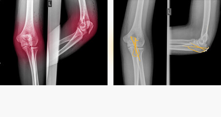 X-ray elbow showing fracture (proximal Ulna or Olecranon fracture) treated by surgery with tension band wiring fixation(TBW). Highlight on medical instrument.Medical healthcare concept. - obrazy, fototapety, plakaty