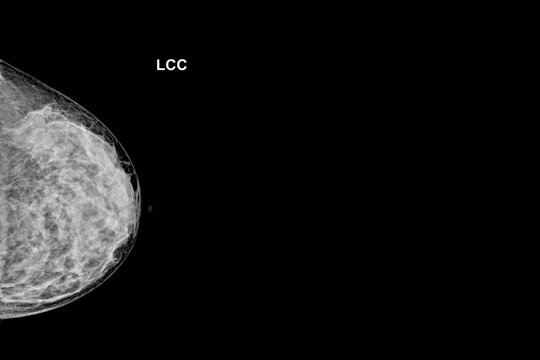 Special Mammogram Image (Craniocaudal view - CC)Examination in Women Over the age of 40 - Left Breast.Medical checkup image concept.
