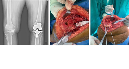 Medical image x-ray knee operation Case severe bone loss varus knee s/p Left Total Knee...