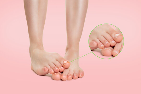 Female feet placed one on top of the other, with nail fungus disease. Zoomed image of the haelthy nails. Pink background. Concept of dermatological diseases and fungi of the foot and nail
