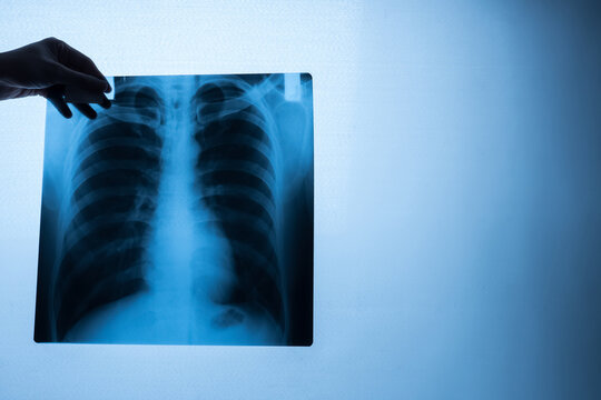 Specialist doctor examining x-ray film of patient.