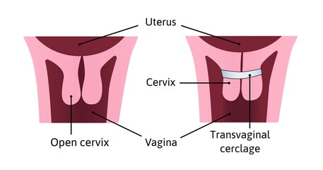 Cervical cerclage tightening of cervical opening during pregnancy. problem, injury. uterus with open cervix and light blue cerclage on it. vector illustration marked with lines. Medical.