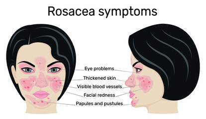 Illustration of the symptoms of rosacea on the example of a female face in full face and profile
