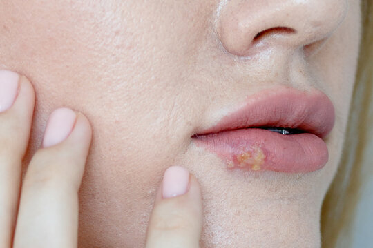 The woman with a virus herpes on lips. Herpes on the lips of the young woman