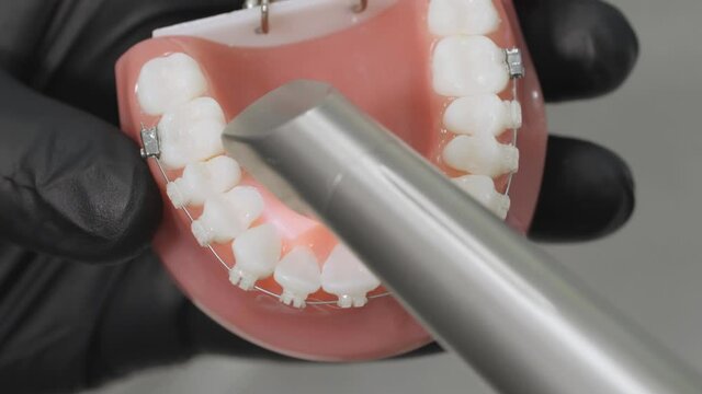 Installation of the bracket system Model Jaw of the teeth the bracket system. Polymerization LED lamp.