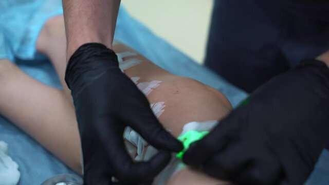 A doctor does medical procedure Sclerotherapy used to eliminate varicose veins and spider veins. An injection of a solution directly into the vein.