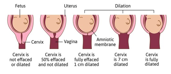 Cervical effacement and dilation during labor or delivery. Cervix changes from not effaced and dilated to fully effaced and totally dilated. Vector medical illustration
