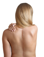 Young woman with scars from spinal surgery.