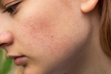Problematic skin. Acne and red festering pimples on the face of a young girl. Facials for teen...