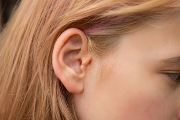 Benign neoplasms of the outer ear in a teenage girl. Congenital ear appendage.