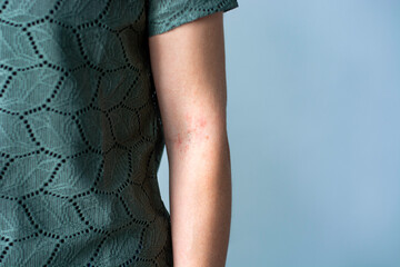 Itchy red bumps on crook of female arm / elbow. Irritated skin rash. Concept of skincare, eczema,...