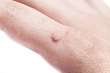 Common wart  Verruca vulgaris  a flat wart commonly found on the hand of children and adults. They are caused by a type of human papillomavirus  HPV